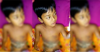 টাকার অভাবে ঝিনাইদহ সদর হাসপাতালেই পড়ে আছে অগ্নিদগ্ধ শিশু সাথি