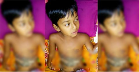 টাকার অভাবে ঝিনাইদহ সদর হাসপাতালেই পড়ে আছে অগ্নিদগ্ধ শিশু সাথি