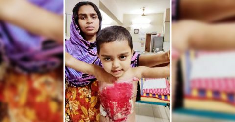 রাজাপুরে অর্থাভাবে অগ্নিদগ্ধ শিশুর চিকিৎসাসেবা ব্যাহত