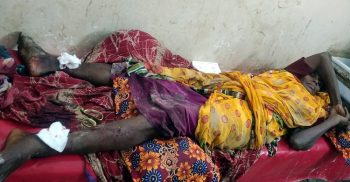 কলাপাড়ায় বোনের দুই পা ভেঙ্গে দিলো ভাই, থানায় মামলা